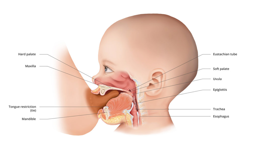 Compromised breastfeeding due to tongue restriction (tie).