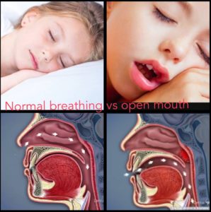 Nasal vs. mouth breathing picture and graphic with children